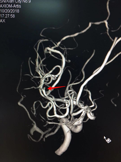 【神经介入】大脑中动脉M2闭塞的取栓治疗