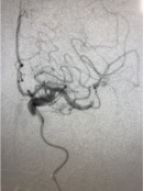 【神经介入】大脑中动脉M2闭塞的取栓治疗