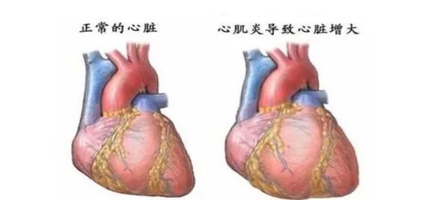 【健康科普】心肌炎患者应该注意什么？